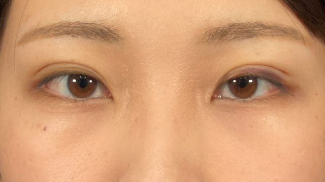 手術前の状態 その1