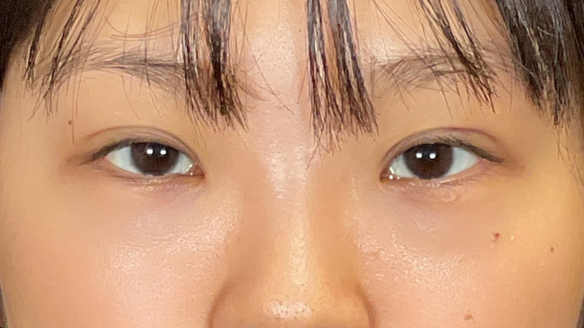 手術前の状態 その1