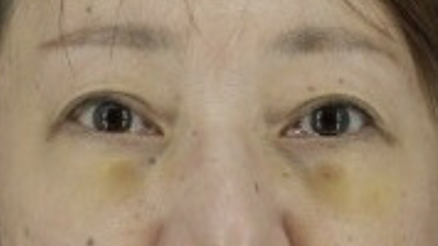 Postoperative Condition Part 1