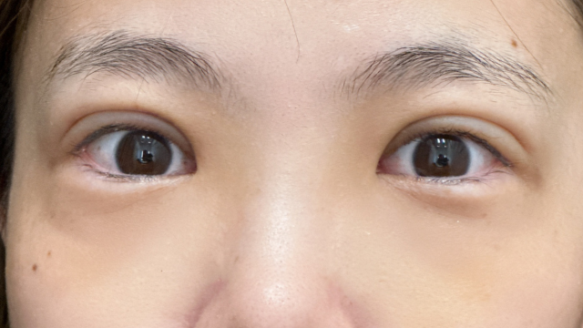 手术前的状态 其一