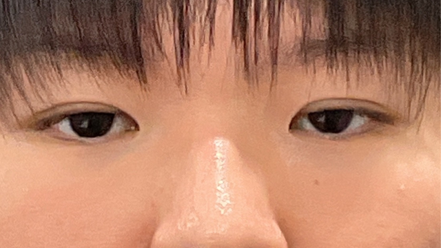 手術前の状態 その1