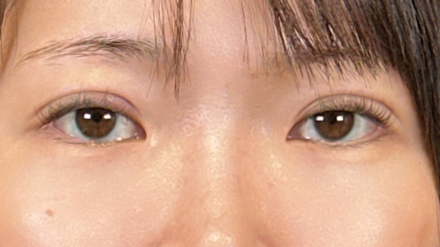 手术前的状态 其一