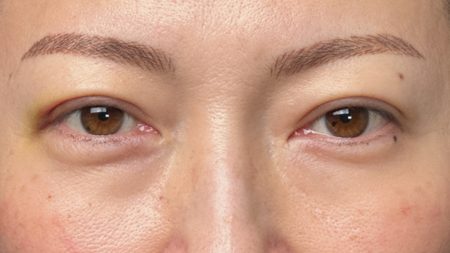 手术前的状态 其一