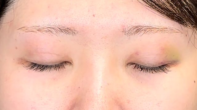 手术前的状态 其一