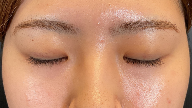 手術前の状態 その1