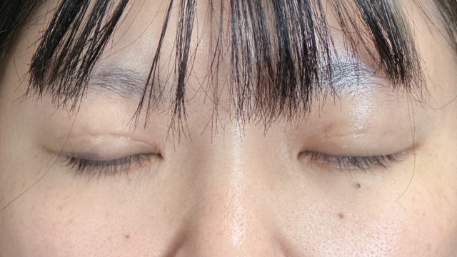 手术前的状态 其一