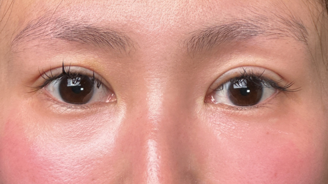 手術前の状態 その1