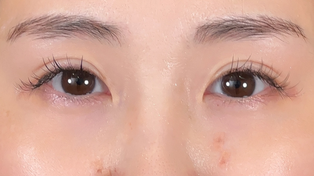 手術前の状態 その1