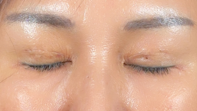 Postoperative Condition Part 1