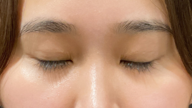 手術前の状態 その1