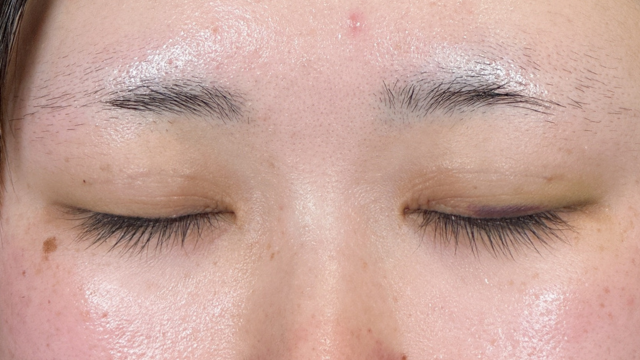 手術前の状態 その1