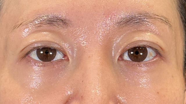 手術前の状態 その1