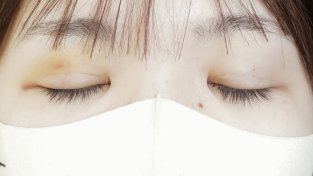 手术前的状态 其一