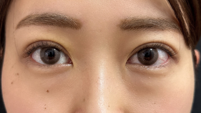 手术前的状态 其一