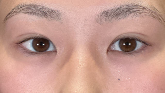 手術前の状態 その1