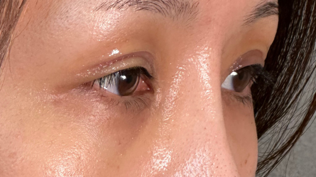 手術前の状態 その1