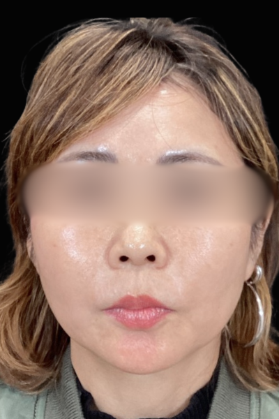 手術前の状態 その1