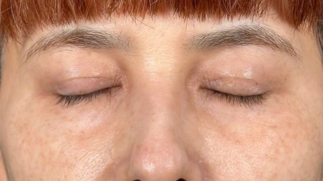 手术前的状态 其一