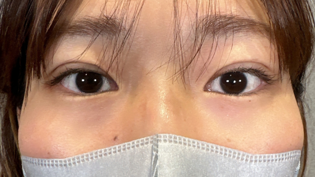 手術前の状態 その1