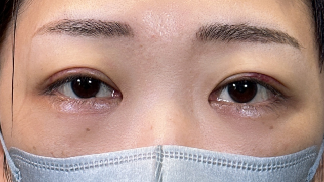 手術前の状態 その1