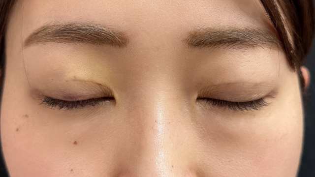 手术前的状态 其一