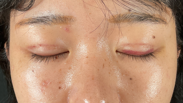 手术前的状态 其一