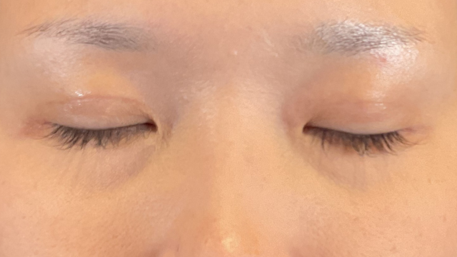 Postoperative Condition Part 1