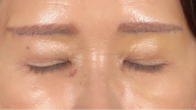 手術前の状態 その1