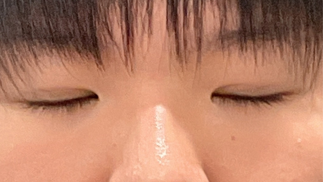 手術前の状態 その1