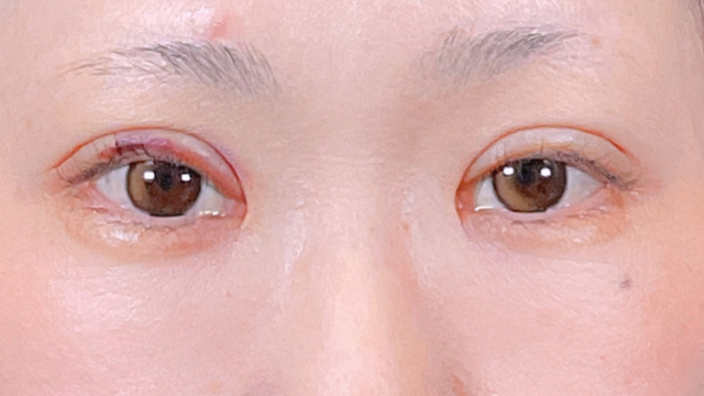 手术前的状态 其一