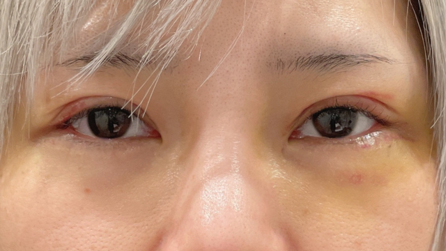 手術前の状態 その1