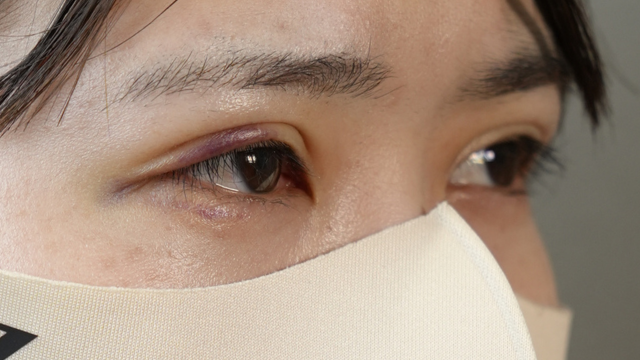 手术前的状态 其一