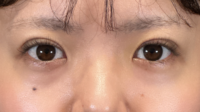 手術前の状態 その1