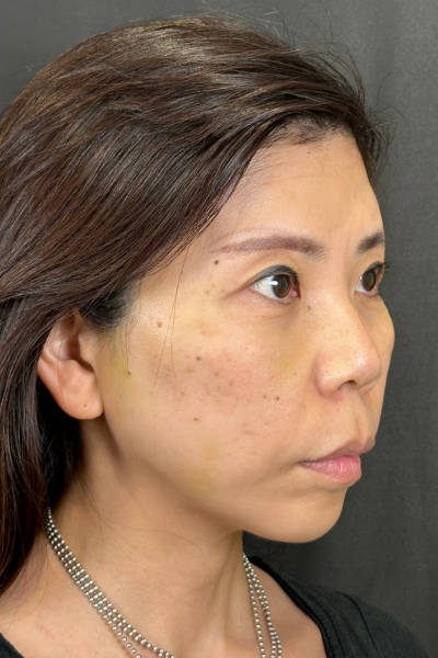 手術前の状態 その1