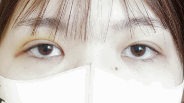 手術前の状態 その1