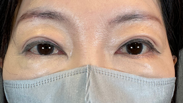 手術前の状態 その1