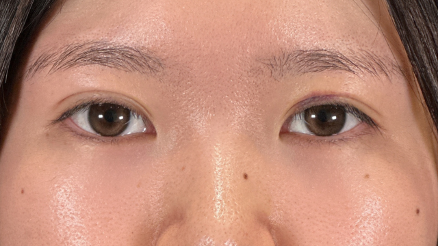 手术前的状态 其一