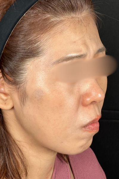 手術前の状態 その1