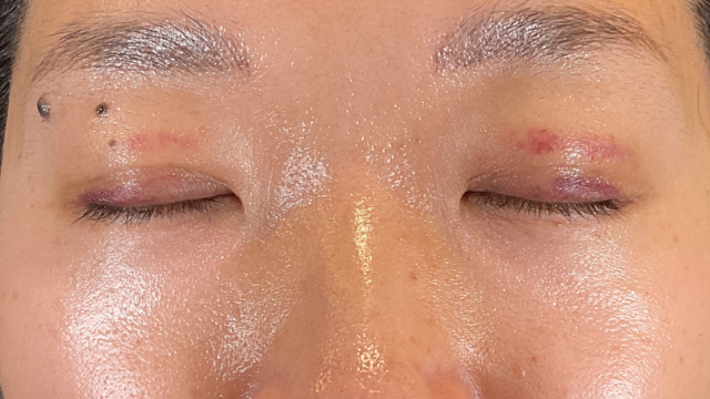 Postoperative Condition Part 1