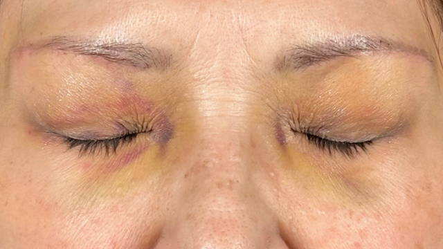 Postoperative Condition Part 1