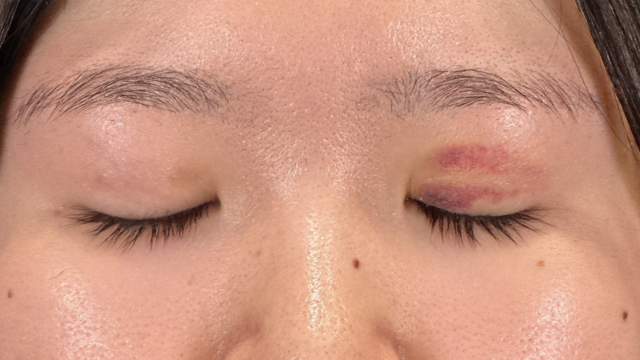 手术前的状态 其一