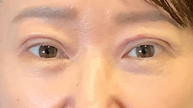 手術前の状態 その1