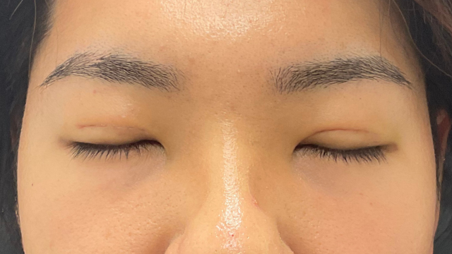 手術前の状態 その1