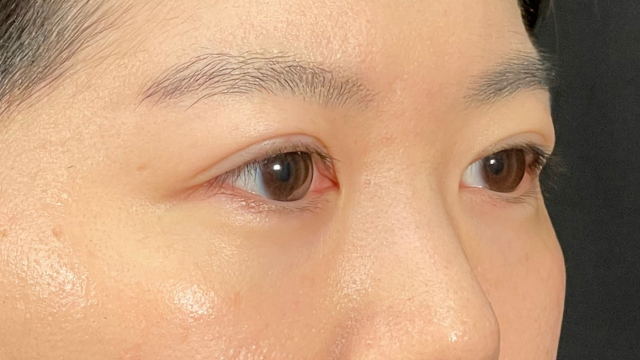 手術前の状態 その1