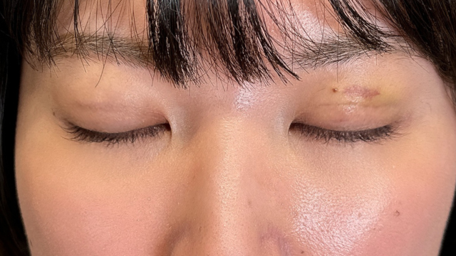 手術前の状態 その1