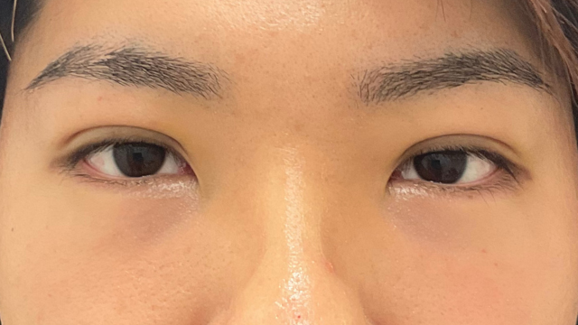 手術前の状態 その1