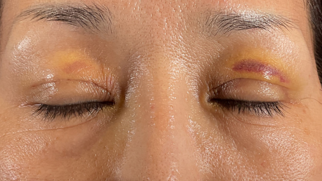 手術前の状態 その1