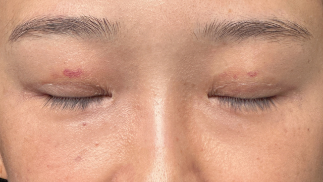 手术前的状态 其一