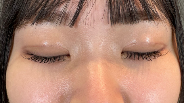 手術前の状態 その1