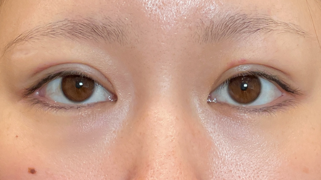 Postoperative Condition Part 1